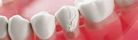 Repairing A Chipped Tooth Dentakay