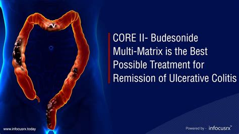 Core Ii Budesonide Multi Matrix Is The Best Possible Treatment For