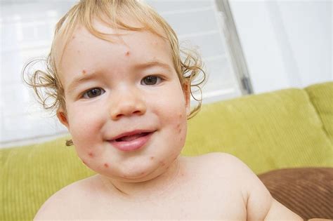 Your Teething Babys Skin Rashes Should You Be Worried Health Studies