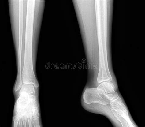 Real X Rays Of The Healthy Lower Leg Front And Side View Stock Image
