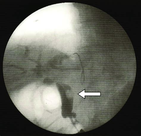 Intraoperative Cholangiography Showing A 10 Mm Common Bile Duct Stone