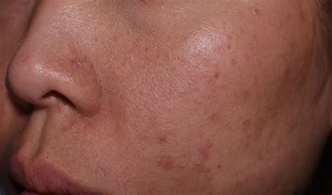 What Causes Dark Spots Tonique Skincare