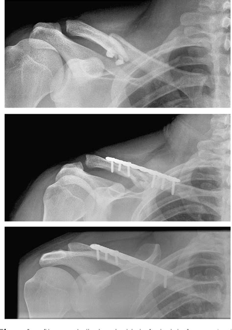 Figure 3 From Locked Intramedullary Fixation Vs Plating For Displaced