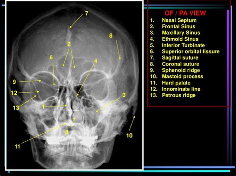 Skull Radiography