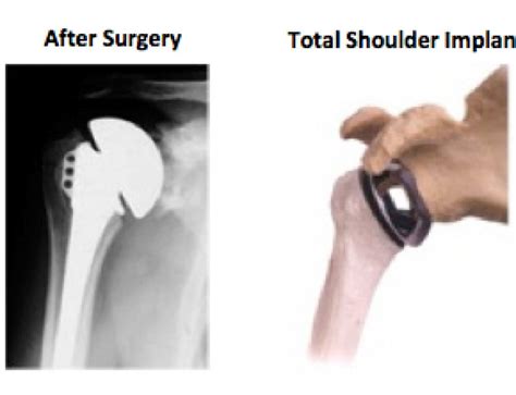 Minimally Invasive Shoulder Replacement Tess Shoulder Arthroplasty