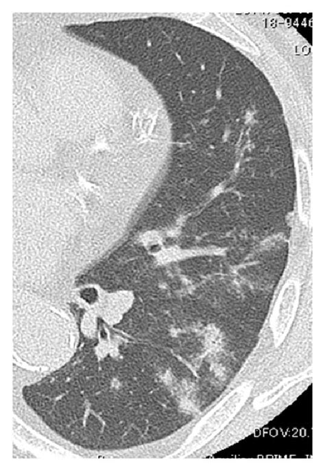 Representative Chest Ct Images Of Pulmonary Cryptococcosis In Inclusive