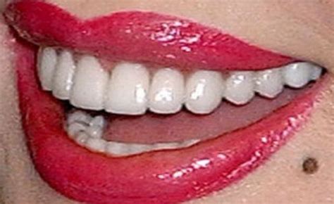 Dolly Parton Teeth Pictures