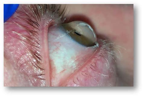 Keratoconus Glaucoma Lasik Ct Connecticut Eye Specialists