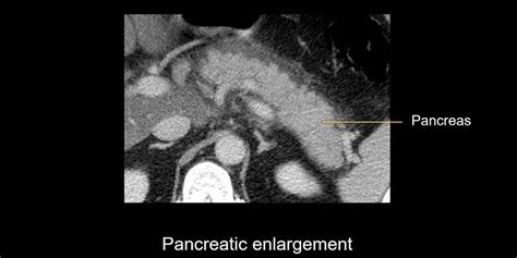 Abdominal Ct Interstitial Pancreatitis Litfl Radiology Library