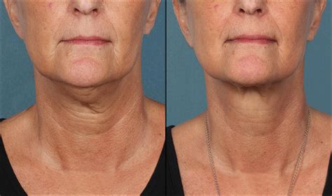 Kybella® Before And After Photos Patient 2 Houston Tx Dermsurgery