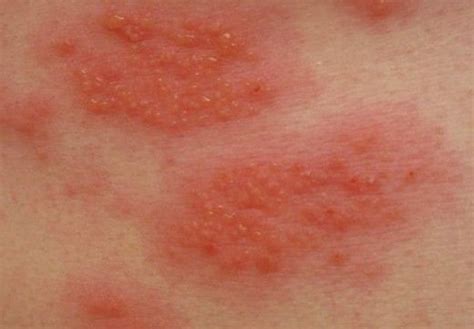 Contact Dermatitis Causes Symptoms And Treatment Index Of Sciences