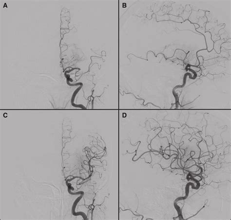 A And B Preoperative Cerebral Angiography Shows Left M1 Occlusion C