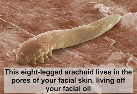 It Also Lays Its Eggs In Your Pores It Eats And Eats Till It Explodes