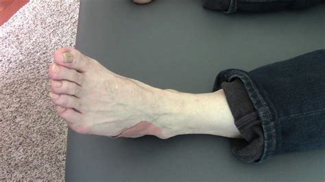 Foot Pain Cuboid Syndrome