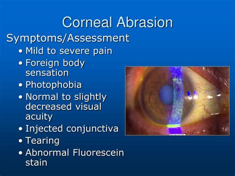 Antibiotic Eye Ointment For Corneal Abrasion