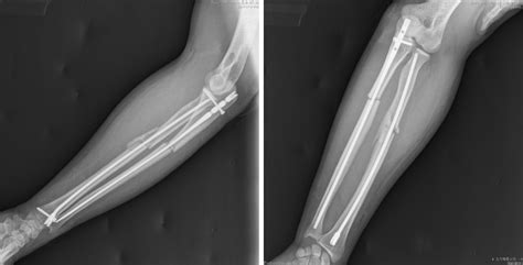 Minimally Invasive Treatment Of Forearm Double Fracture In Adult Using