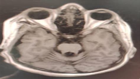 Figure 1 From Jouberts Syndrome A Case Report Semantic Scholar