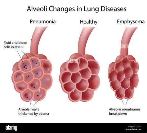 Alveolen Und Lungenerkrankungen Stockfotografie Alamy