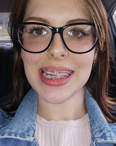 Pin On Braces And Glasses