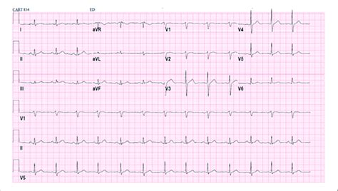 Previous Electrocardiogram Showing Normal Sinus Rhythm Rate Of 81 Bpm