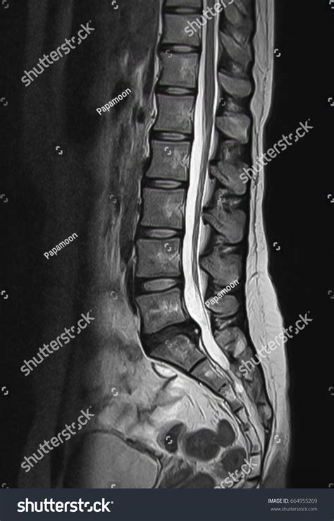 Mri Scan Sagittal View Lumbosacral Spine Photo De Stock Modifiable