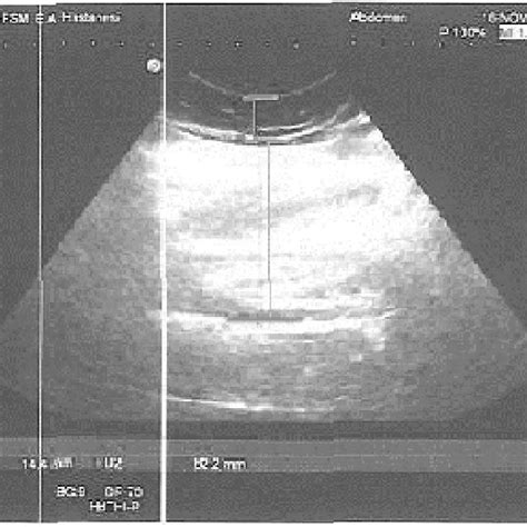 Ultrasound Image Of Measurements Of The Thickness Of Subcutaneous Fat