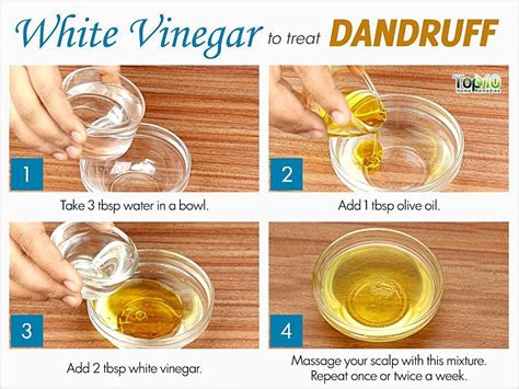 Pin By Julie Rockwell On Hair In 2020 Home Remedies For Dandruff Dandruff Remedy Hair Dandruff
