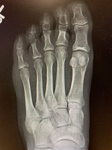 What Does A Broken Pinky Toe Look Like On X Ray Sprained Pinky Toe Or