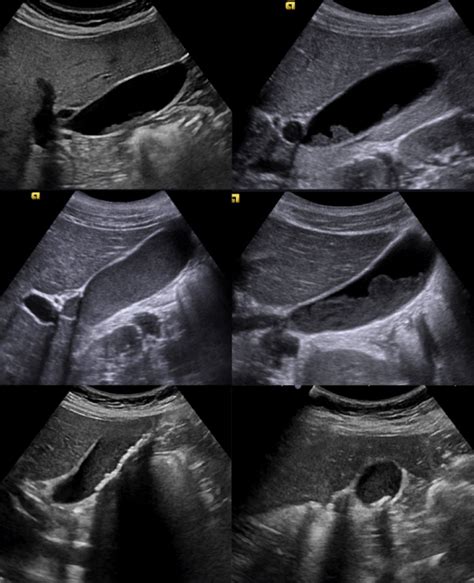 Ultrasonography Of The Gallbladder Shows Inhomogeneous Content