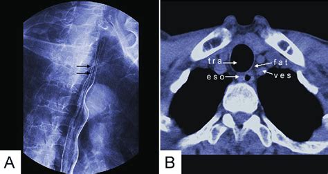 Gas Barium Double Contrast X Ray Image A And Ct Axial View Image