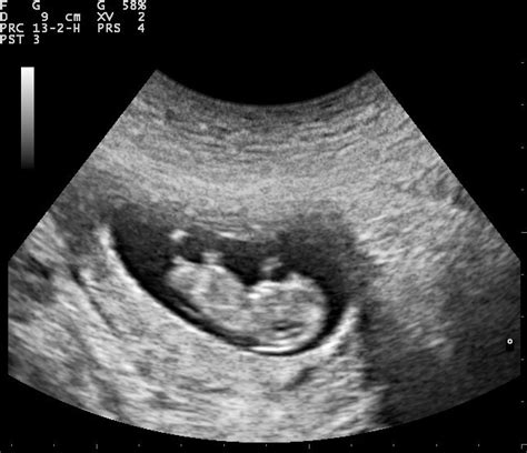 You're so close to being out of this awful first trimester. My Near-Abortion Experience: What I Would Have Missed ...