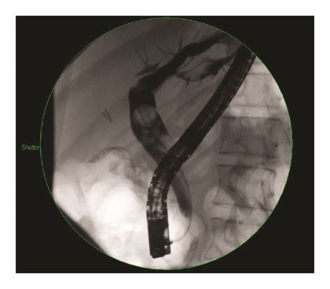 Ercp Showing Multiple Cbd Stones Note That The Right Hepatic Duct Is
