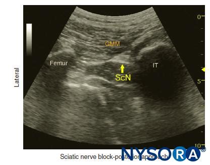 Sciatic nerve block provides postoperative pain relief after below. Ultrasound-Guided Sciatic Nerve Block - NYSORA