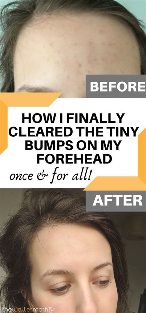 How I Finally Cleared The Tiny Bumps On My Forehead And Created A