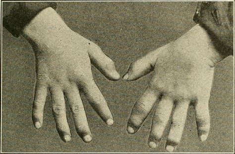 Six Causes Of Dactylitis Sausage Fingers