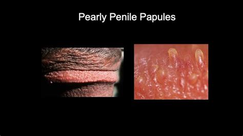 Doctor Explains Pearly Penile Papules Small Lumps On The Head Of The