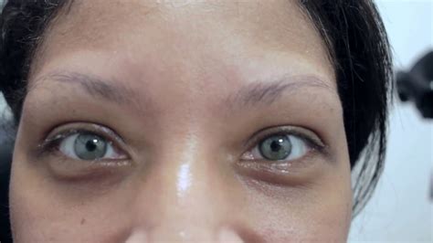 Laser Eye Color Surgery Before And After Pixshark Coloring Wallpapers Download Free Images Wallpaper [coloring436.blogspot.com]