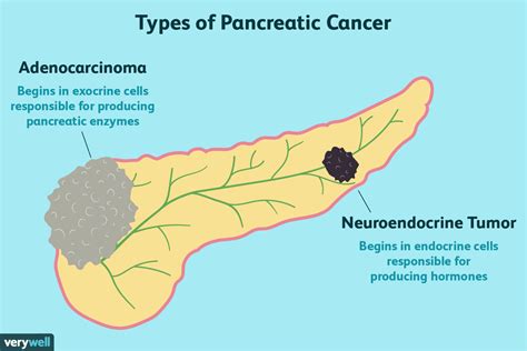 Types Of Pancreatic Cancer