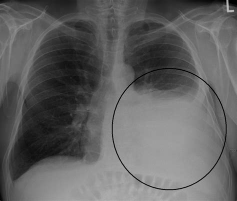 Diagnosing A Pleural Effusion X Ray Pictures And Treatment