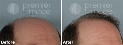 Hair Transplant Atlanta Ga Hair Loss Restoration Fut Surgery