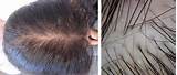 Hair Loss On Both Sides Of Head Photos