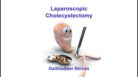 Gallbladder Removal Laparoscopic Cholecystectomy With Left Ventral