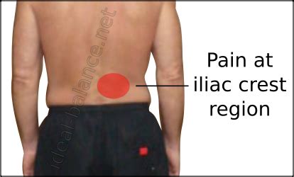 Ideal Balance Acupuncture Iliac Crest Syndrome