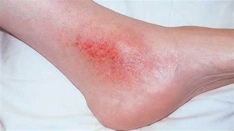 Brown Skin Discoloration On Lower Legs Dark Spots On Legs Diabetes