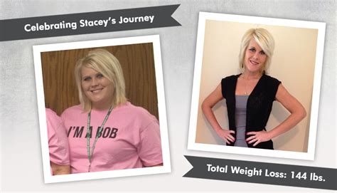 Before And After Rny With Stacey Losing 144 Lbs Obesityhelp