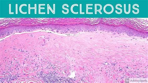 Lichen Sclerosus Et Atrophicus Inflammatory Dermpath Basics For