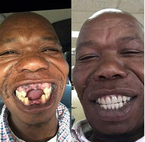Latest Updates Wow Toothless Man Gets Perfect Set Of Teeth