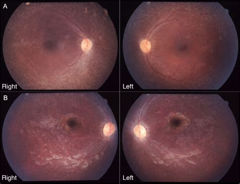 Fundus Photographs Of Patients Ii 1 And Ii 2 A And B Fundus