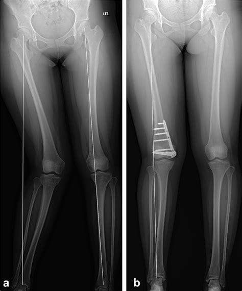 Recurrent Patellar Dislocation With Spontaneous Valgus Knee Deformity