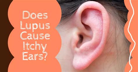 Does Lupus Cause Itchy Ears Mylupusteam